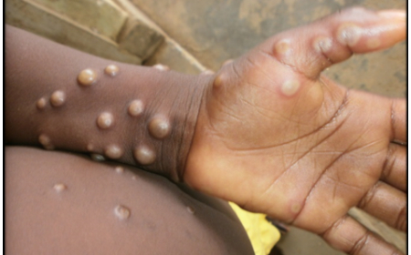 अफ्रिकी मुलुकमा मंकीपक्सको संक्रमण फैलिएपछि स्वास्थ्य आपतकाल घोषणा